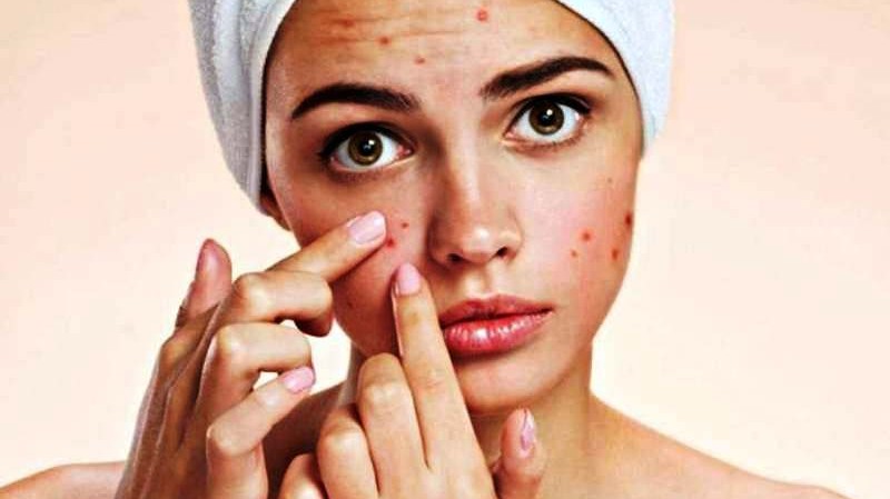 डन्डिफोर नियन्त्रणका लागि १० प्रभावकारी घरेलु उपाय