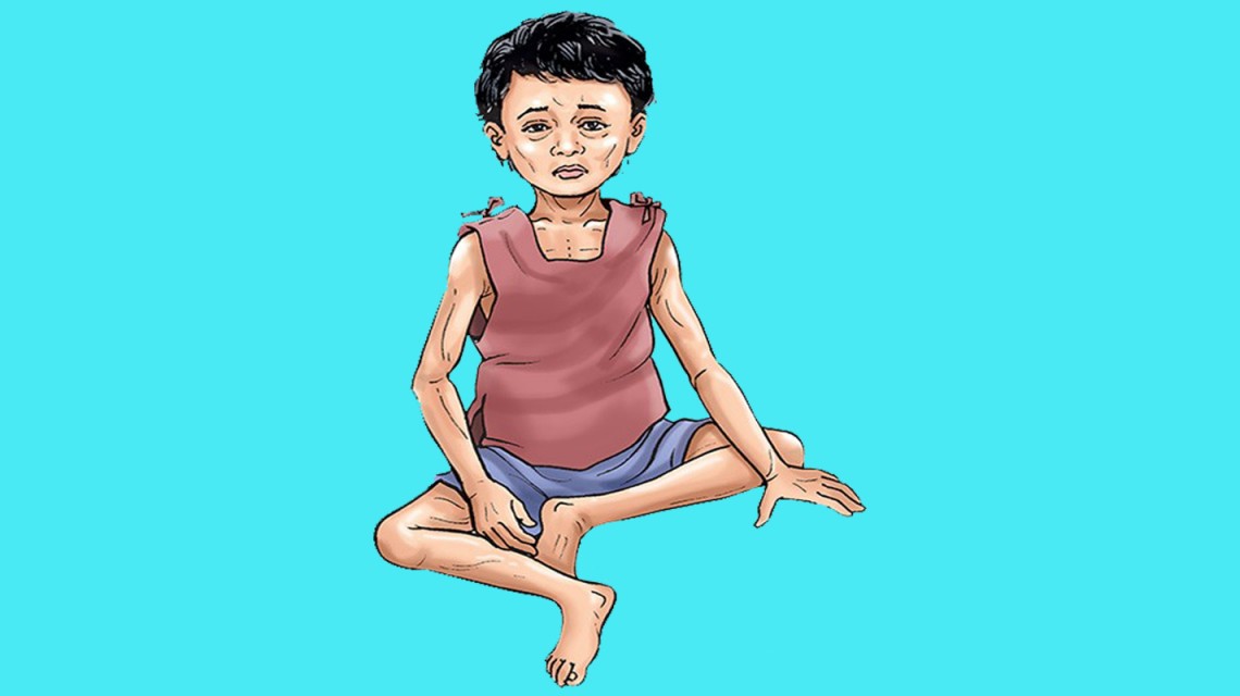 पोषण परीक्षणमा खुल्यो बाल कुपोषणको वास्तविक अवस्था