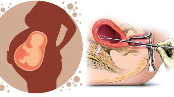 असुरक्षित गर्भपतनका कारण मातृ मृत्यु अझै चुनौतीपूर्ण