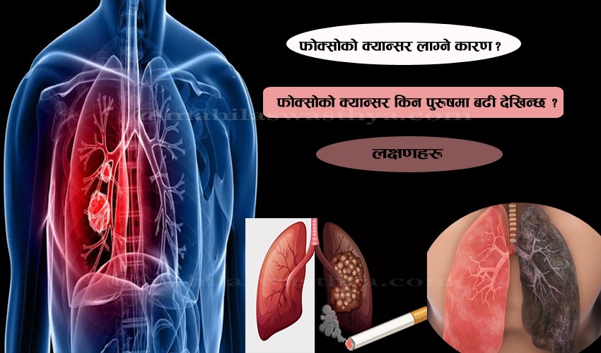 पुरुषमा बढ्दो फोक्सोको क्यान्सर: कारण र बच्ने तरिका