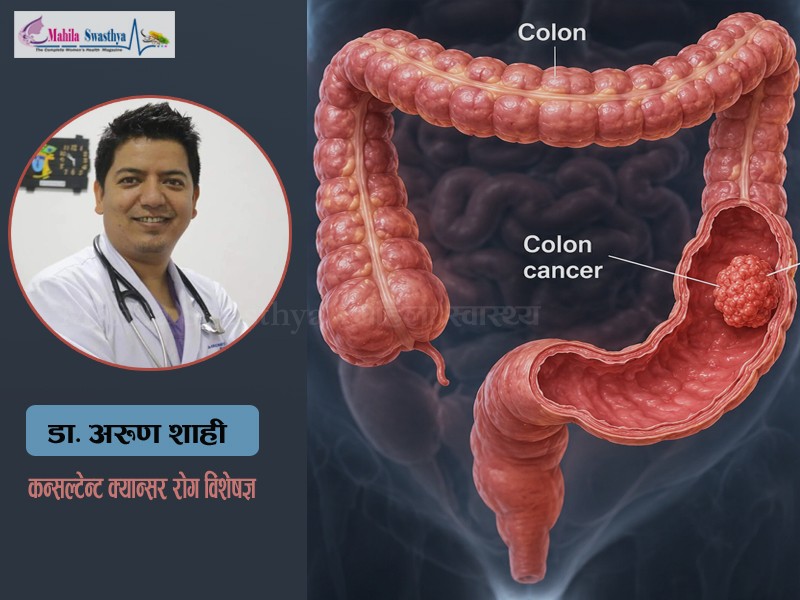 के कारणले हुन्छ ठूलो आन्द्राको क्यान्सर ? लक्षण र बच्ने उपाय