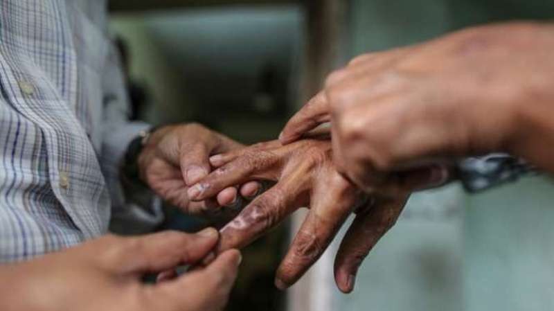 बैतडीमा कुष्ठरोगका बिरामी घट्दै