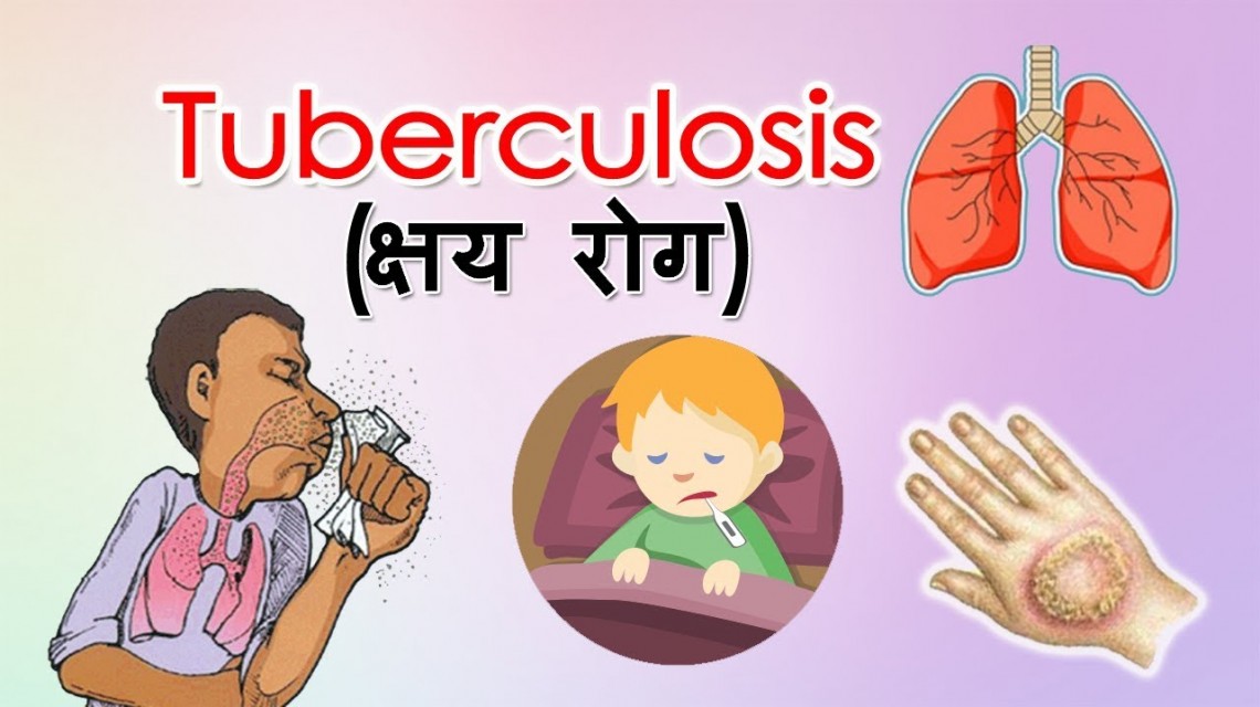 मेचीनगरमा तीन वर्षमा ६६१ क्षयरोगी फेला, ९४ प्रतिशत उपचारपछि निको