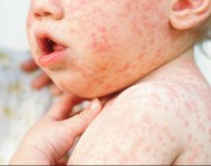 बागलुङमा दादुरा नियन्त्रणतर्फ, खोप अभियान प्रभावकारी