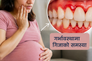 गर्भावस्थामा गिजाको समस्या : आमा र बच्चाको स्वास्थ्यमा कस्तो असर पर्छ?
