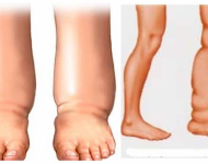 बाँकेमा हात्तीपाइले विरुद्ध १६औँ आम औषधि सेवन अभियान सुरु