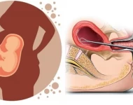 असुरक्षित गर्भपतनका कारण मातृ मृत्यु अझै चुनौतीपूर्ण