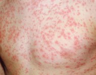 ढोरपाटनमा दादुरा अझै नियन्त्रणमा छैन