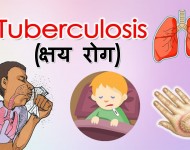 मेचीनगरमा तीन वर्षमा ६६१ क्षयरोगी फेला, ९४ प्रतिशत उपचारपछि निको