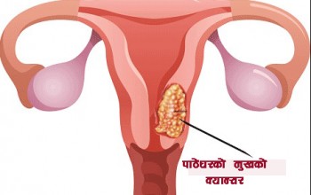 टीकापुरमा पाठेघरको मुखको क्यान्सर परीक्षण शिविर