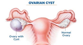 ओभरियन सिस्ट के हो ? कारण, लक्षण र बच्ने उपाय