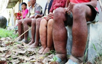 झापामा आठ लाखलाई हात्तीपाइले रोगविरुद्धको औषधि