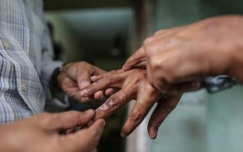 मधेश प्रदेशमा जनस्वास्थ्य समस्याको रुपमा कुष्ठरोग
