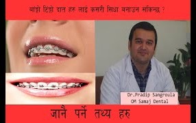 बांङ्गो टिंङ्गो दात हरु लाई कसरी सिधा बनाउन सकिन्छ जानै पर्ने कुरा हरु