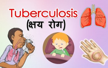 झापामा क्षयरोगका ६१६ जना नयाँ बिरामी फेला