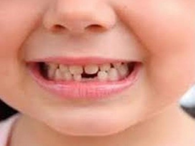  बच्चाको दाँत विग्रिनबाट कसरी बचाउने ? यस्ता छन् उपायः 
