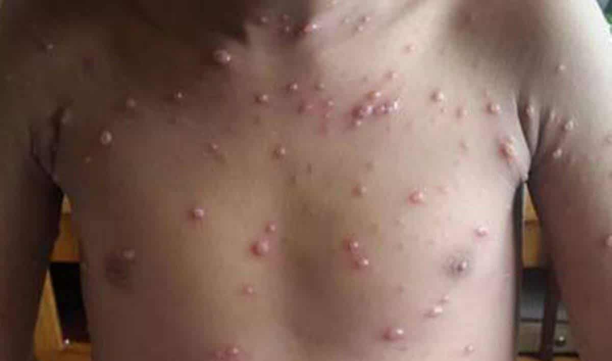 ठेउला किन आउँछ ? यसबाट कसरि जोगीन सकिन्छ ?