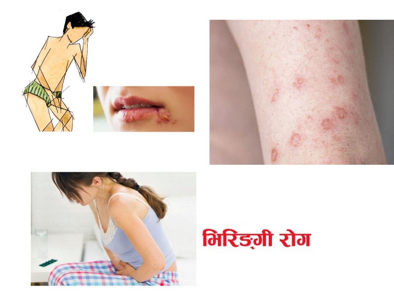 समयमै उपचार नगराउँदा भिरिंगीले निम्त्याउँछ अन्य गम्भिर रोग