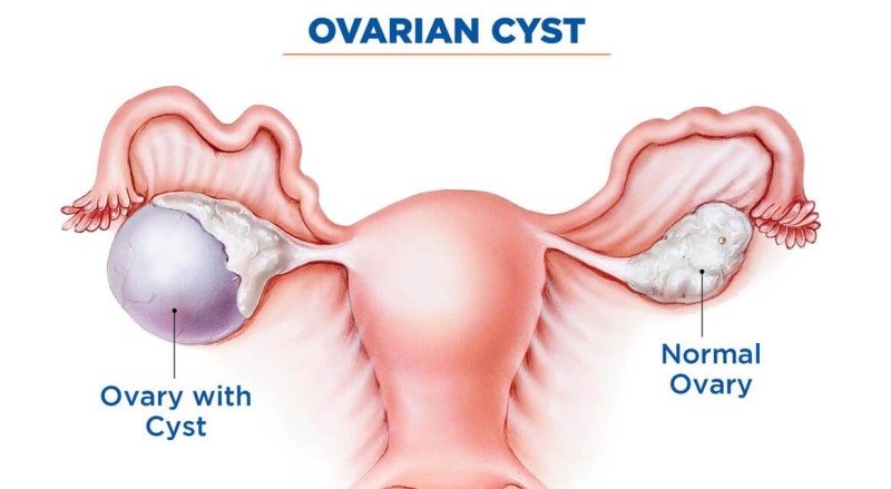 ओभरियन सिस्ट के हो ? कारण, लक्षण र बच्ने उपाय