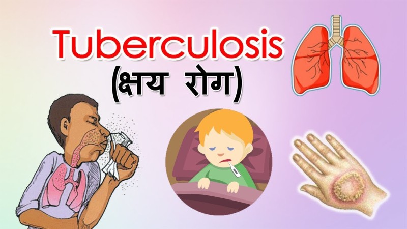झापामा क्षयरोगका ६१६ जना नयाँ बिरामी फेला