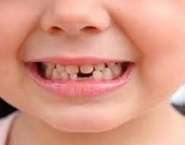  बच्चाको दाँत विग्रिनबाट कसरी बचाउने ? यस्ता छन् उपायः 