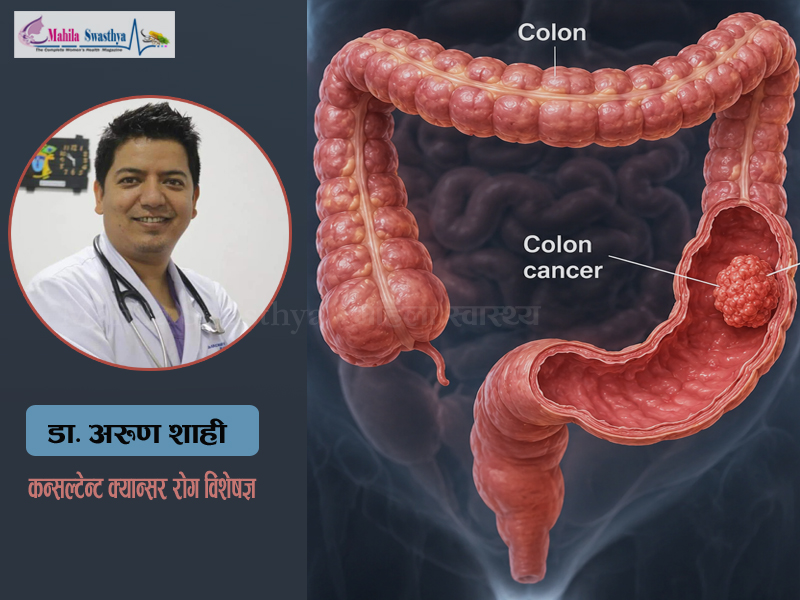 के कारणले हुन्छ ठूलो आन्द्राको क्यान्सर ? लक्षण र बच्ने उपाय
